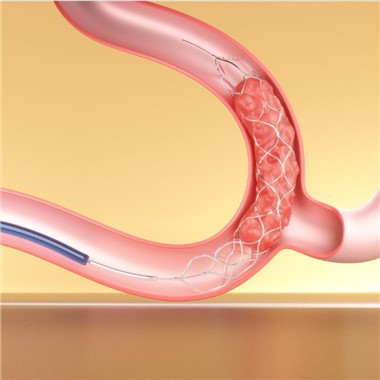 Dispositivi per trombectomia con stent retriever